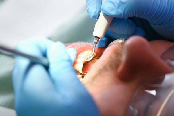 Best Emergency Root Canal Therapy in Oxford, MS